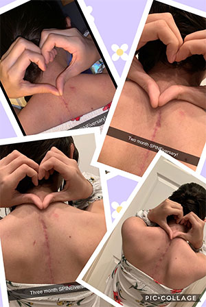 【Paley研究院案例】Ashley的脊柱矫正之路：从恐惧到重返生活