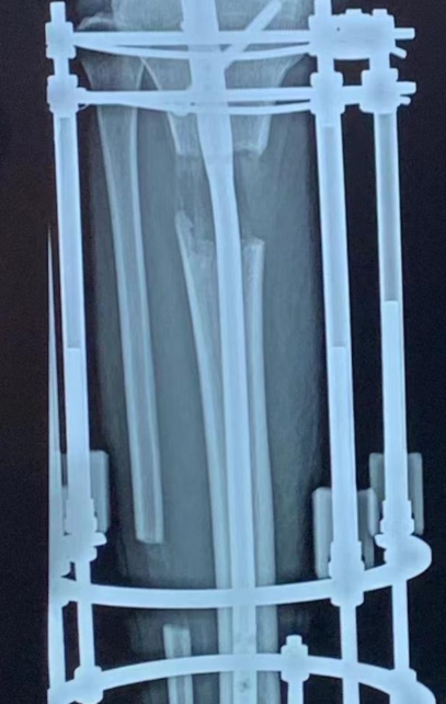 Paley 研究院：全球增高技术与材料发展对比及行业引领者视角