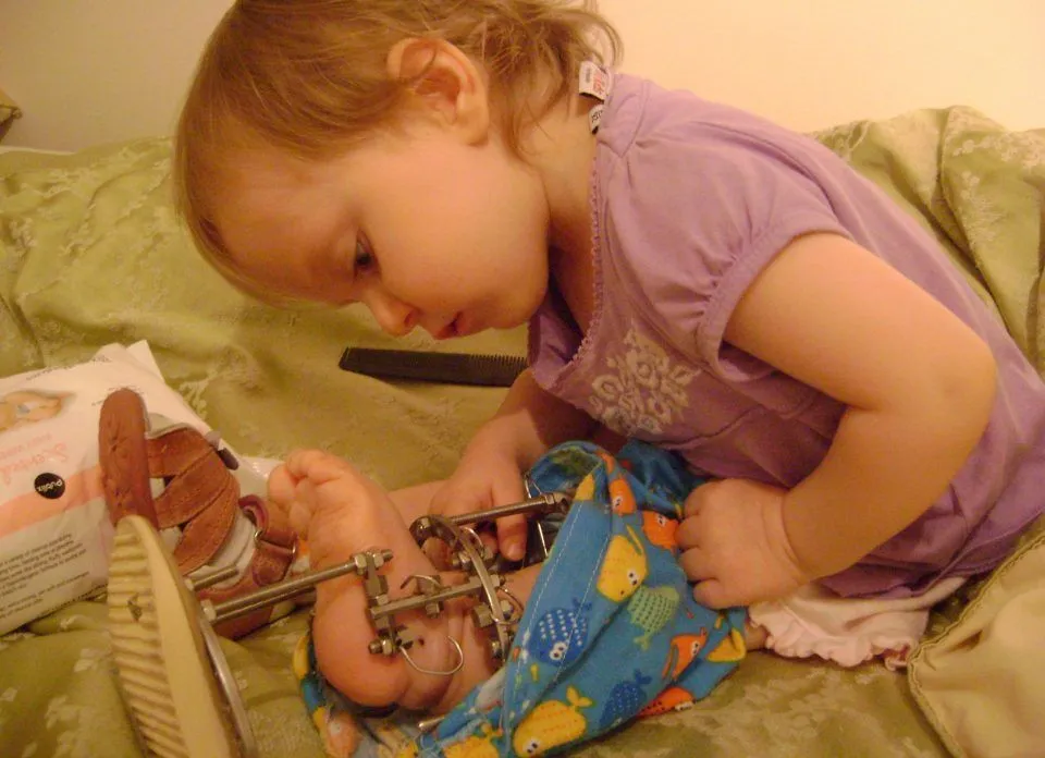 安娜的康复故事：Paley医生治疗先天性胫骨假关节（CPT）的案例