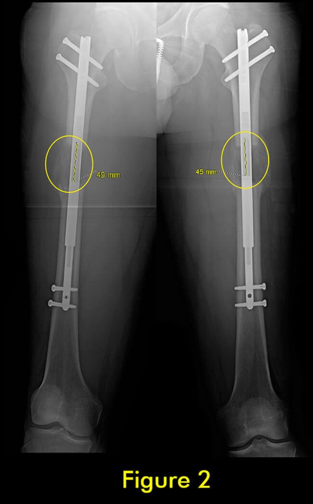 过早合并示意图2