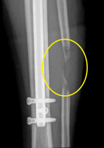 患者在外部设施中延长后出现间歇愈合